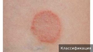 Гранулема кольцевидная. Как лечить гранулему кольцевидную.