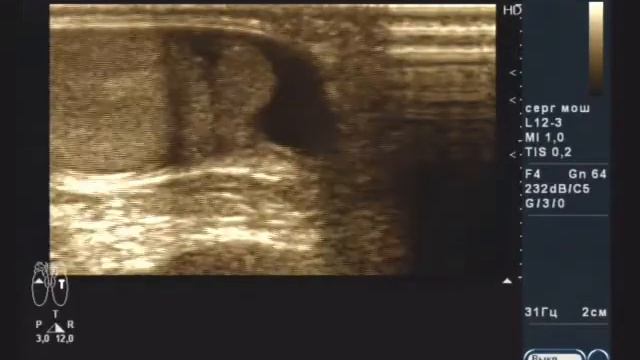 Острый эпидидимит смотреть онлайн