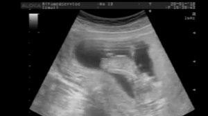 ?? УЗИ.12 недель. Монохориальная беременность-двойня. Ultrasound -twins.Поля и Даша в животике