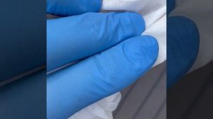 Удаление вросшего ногтя #вросшийноготь