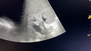 Асцит, портальная гипертензия, билиарный сладж. Цирроз печени.