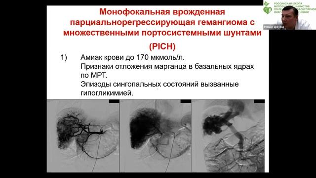 2022.01.20 Рентгенэндоваскулярная диагностика и лечение в педиатрии (Гарбузов Роман Вячеславович) смотреть онлайн