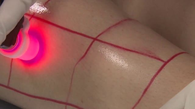 Alexandrite ütüleme Lazer Sistemi Deka Lazer смотреть онлайн