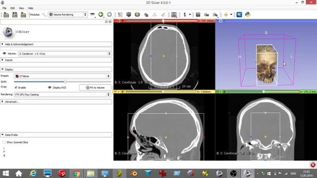 создание 3d-модели .stl для 3d-печати из данных КТ смотреть онлайн