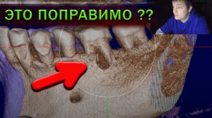 Периодонтит - вторичная эндодонтия и деструкция в бифуркации - перелечивание  корневых каналов зуба