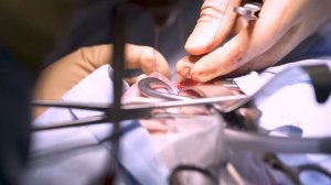 Аугментационная пластика стриктуры уретры в Ильинской больнице.