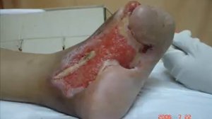 Гангрена при диабете