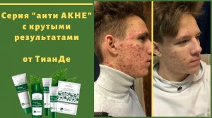 Серия анти АКНЕ с крутыми результатами (АКЦИЯ) l ТианДе