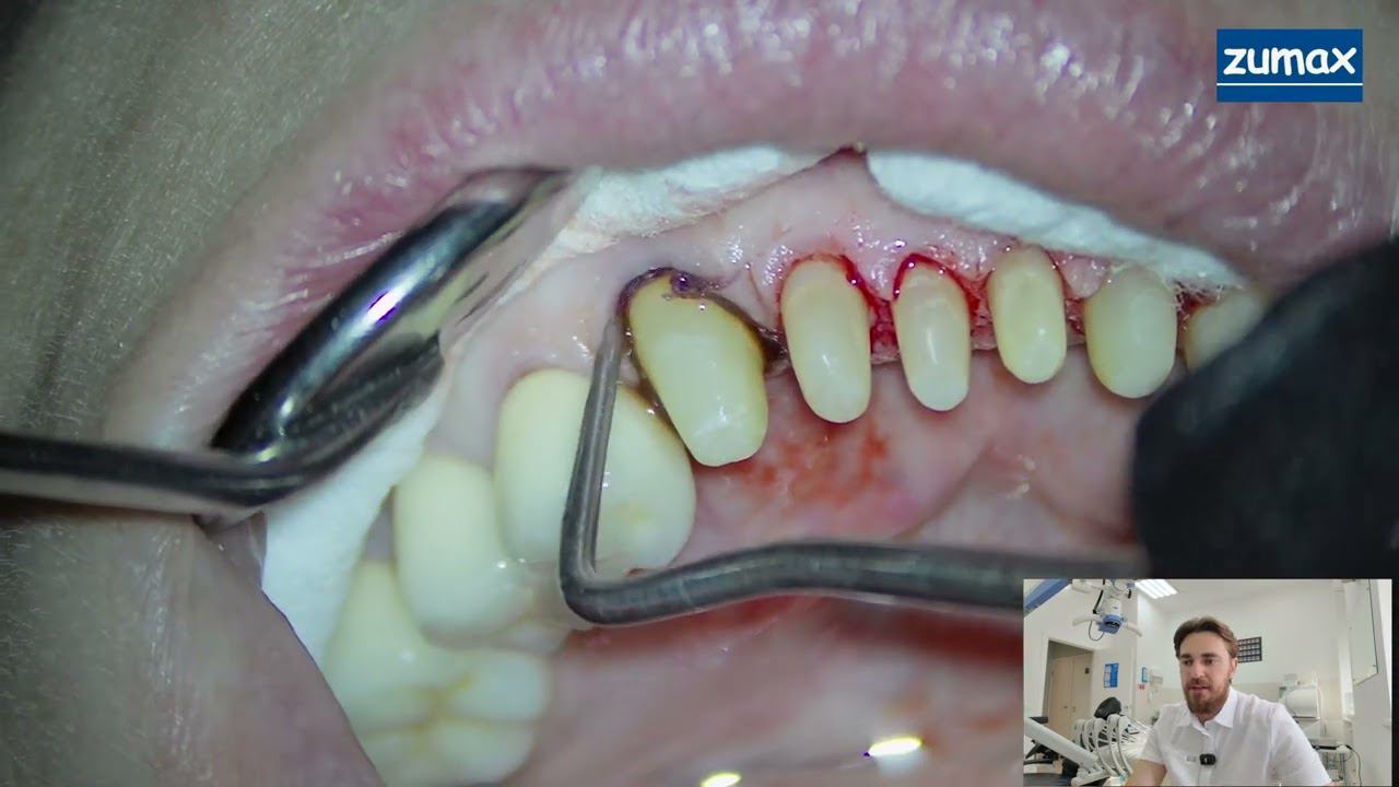 СТОМБУДНИ#40 САМЫЙ БЫСТРЫЙ ВЕРТИПРЕП С "КЕТЧУПОМ" И ОТТИСК смотреть онлайн