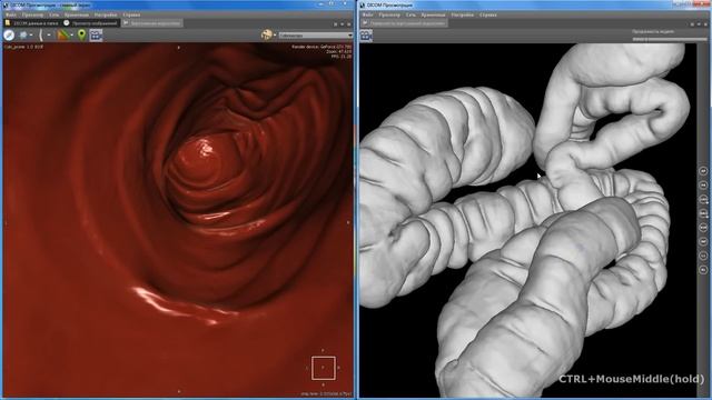 Virtual Colonoscopy. Camera Flight.