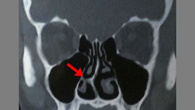 ринопластика - мой опыт пластики носа