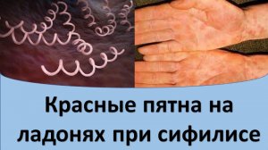 Красные пятна на ладонях при сифилисе
