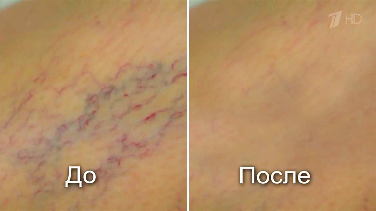 Как избавиться от варикоза? Здоровье. Фрагмент выпуска от 18.09.2016