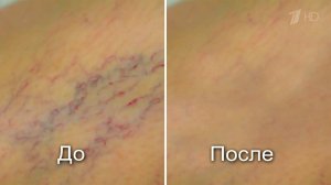 Как избавиться от варикоза? Здоровье. Фрагмент выпуска от 18.09.2016