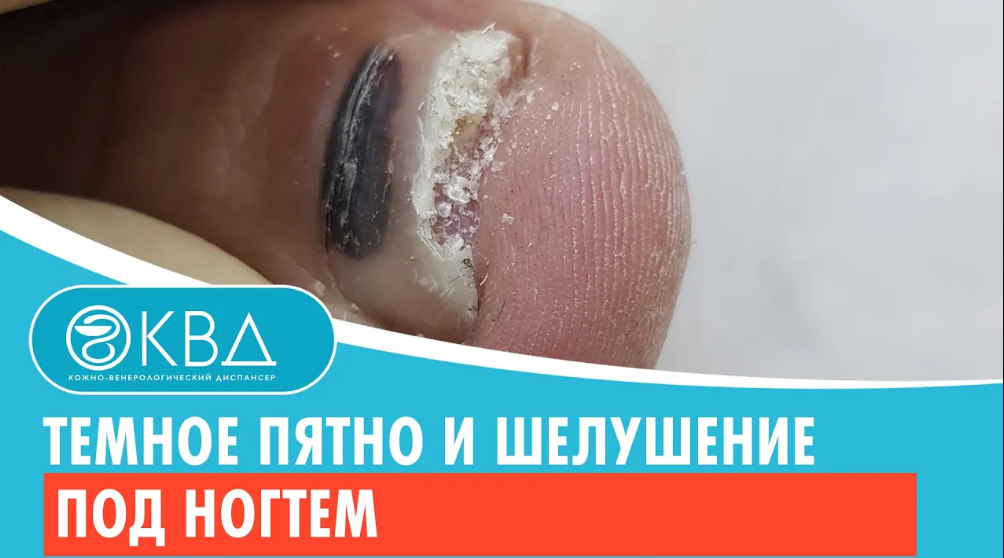 ? Темное пятно и шелушение под ногтем. Клинический случай №560
