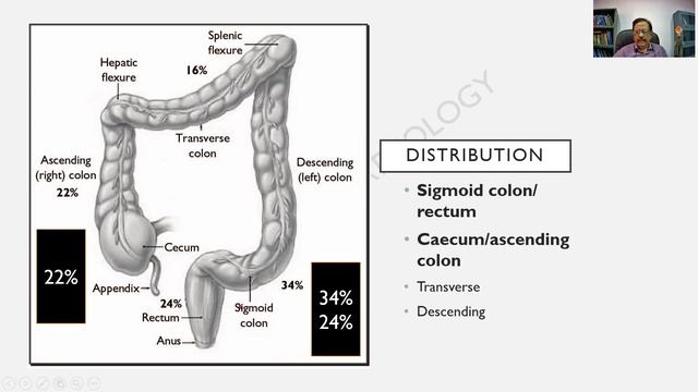 Colorectal Carcinoma | GIT | RATS in Pathology | Dr G.Shivashekar | SRM | MBBS | University Q's !!! смотреть онлайн