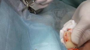 Вросший ноготь на руке