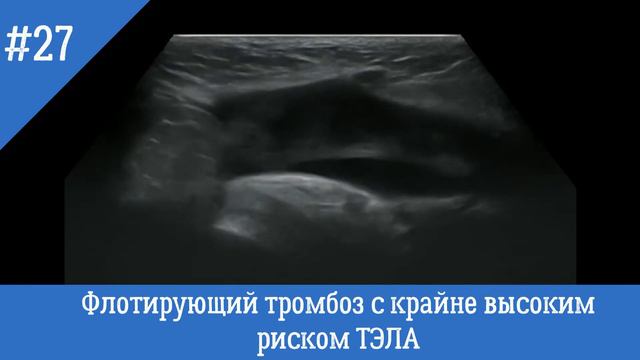 УЗИ сосудов. Острый флотирующий тромбоз с высокис рискомТЭЛА