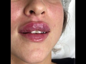 Увеличение губ