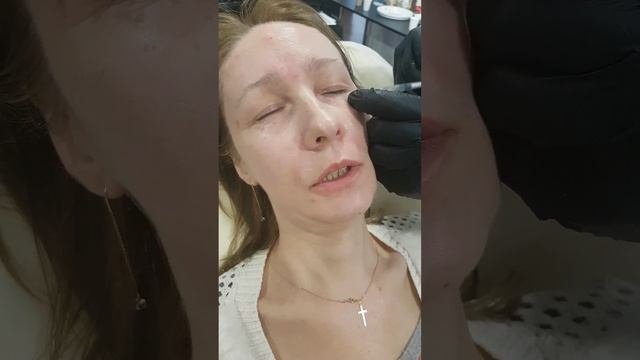 Убираем мимические морщины лба, возле глаз, межбровья и кроличьи морщины.
