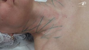 Биоармирование канюлей