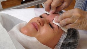 Введение мезонитей при морщинах между бровей