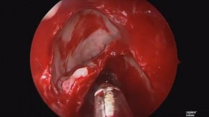 Functional Endoscopic Sinus Surgery (FESS) for Chronic Rhinosinusitis