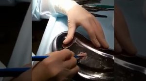 Ринопластика