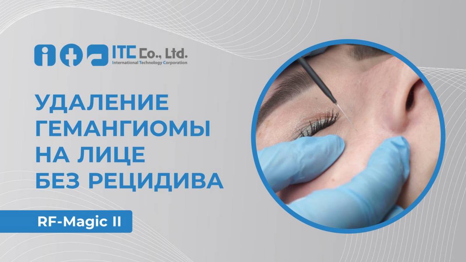 Удаление гемангиомы.