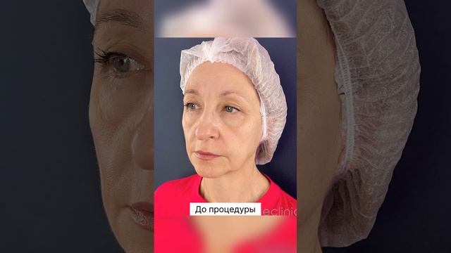 До и после процедуры FULLFACE