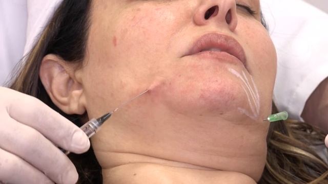 פרופ קסוטו טיפול באמצעות חומצה היאלרונית NEAUVIA смотреть онлайн