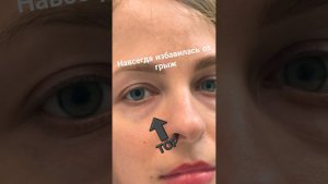 избавилась от грыж под глазами , хочешь так же? пиши в личку ) #блефаропластика #пластика