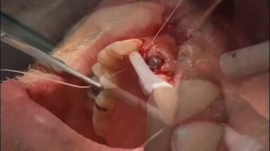 5) ASTRA TECH Implant System - Suturing