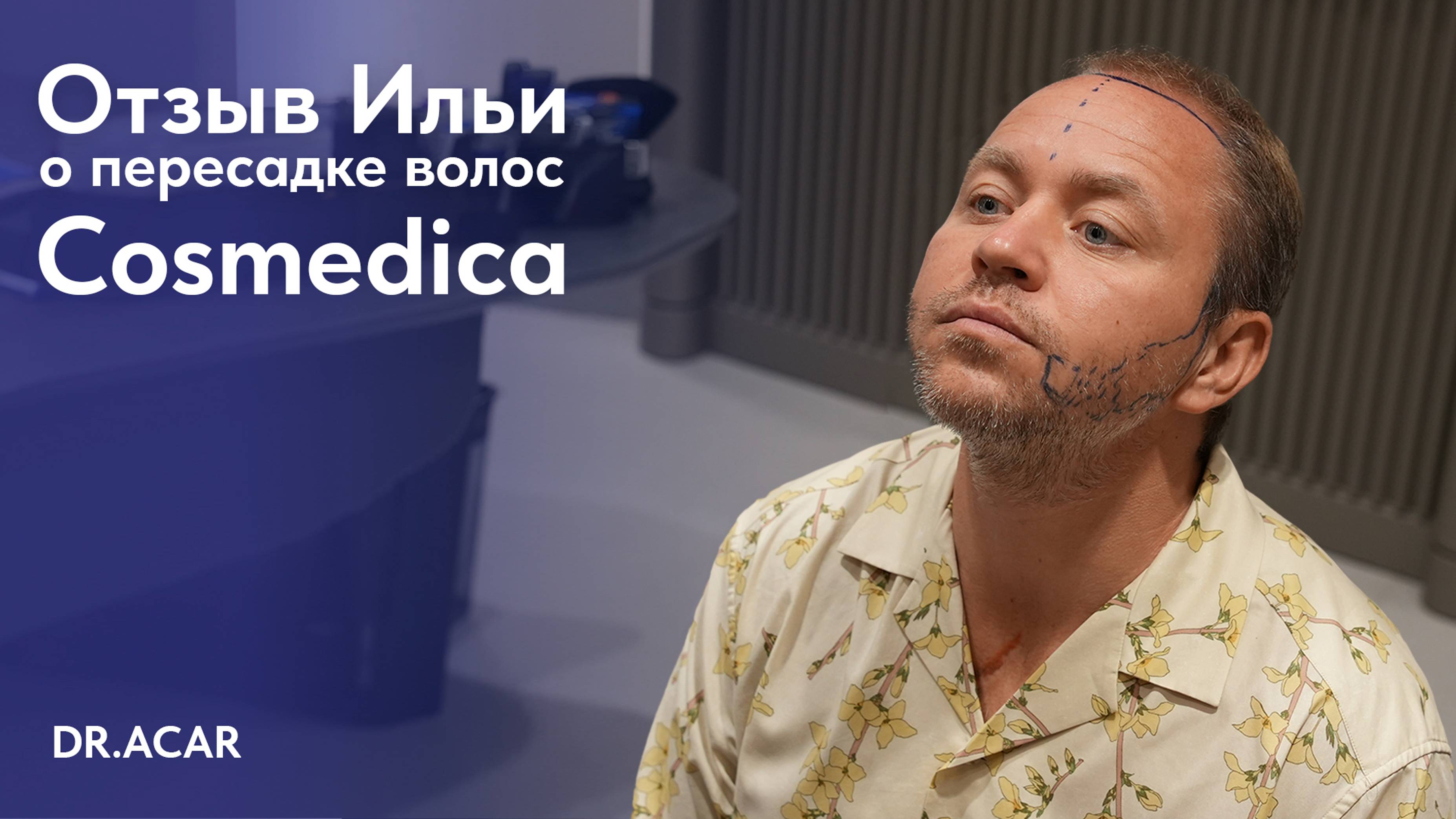 Пересадка волос и бороды в Турции | Опыт Ильи с Cosmedica - доктор Acar