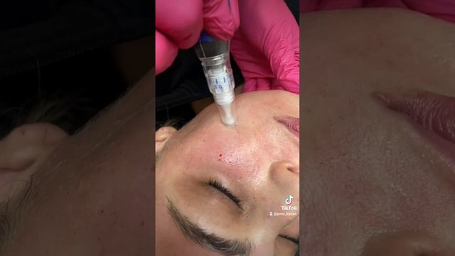 Microneedling can help improve the appearance and texture of your skin.