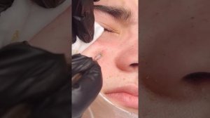 Механическая чистка лица