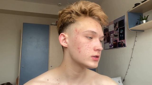 КУРС ЛЕЧЕНИЯ КОЖИ ДОКСИЦИКЛИНОМ | ЧТО С КОЖЕЙ СПУСТЯ 1 МЕСЯЦ ЛЕЧЕНИЯ | ВИДЕО 2 смотреть онлайн