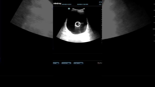 Как выглядит катетер в мочевом пузыре? смотреть онлайн