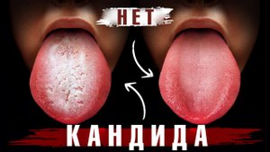 Начните делать это сейчас – и избавитесь от кандидоза навсегда!?