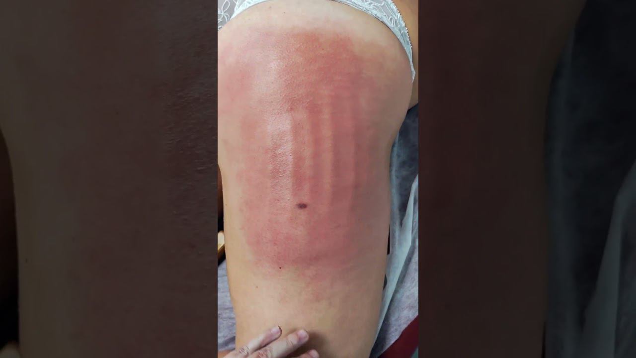Ручная липосакция галифе #shortvideo #massage #массаж #music #похудение #tiktok #ноги
