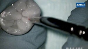 Реставрация зуба 3.6 от Ивана Рузина