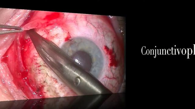 Management of Conjunctival Melanoma
