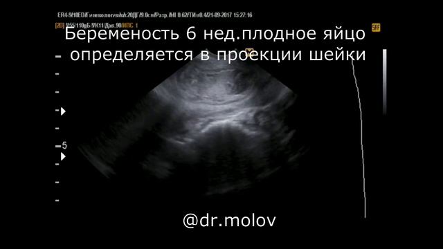 Выкидыш в ходу на 6-7 неделе, 2 случая на УЗИ органов малого таза