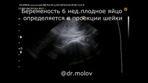Выкидыш в ходу на 6-7 неделе, 2 случая на УЗИ органов малого таза