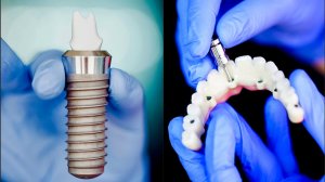 Способы вернуть деньги за импланты! Ошибка стоматолога. Некачественные услуги