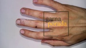 Первая помощь при ожоге: как избавиться от боли и следа после ожога