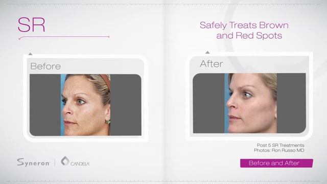 Body + Beauty Laser IPL Advanced powered by Syneron-Candela elōs Plus смотреть онлайн