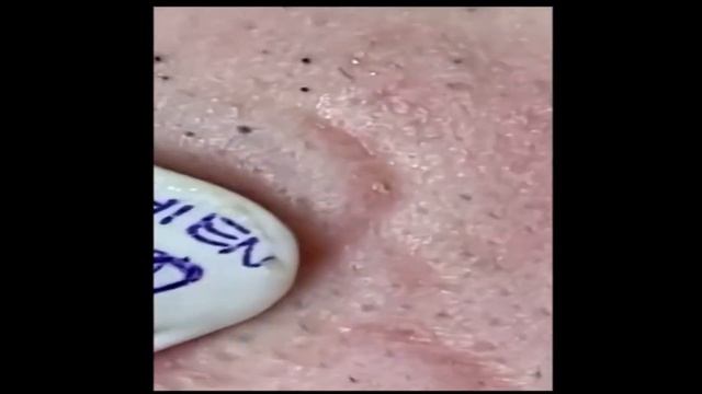 Удаление черных точек / Лечение акне / Removing blackheads / comedones