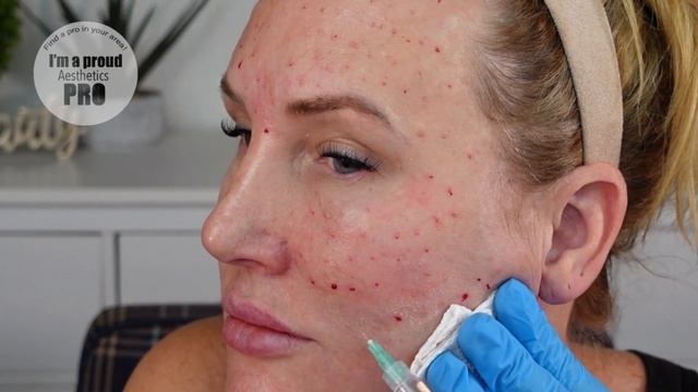 Lemon Bottle Mesotherapy // Full Tutorial