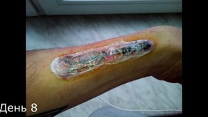 Выжигание татуировки йодом. 2 неделя.